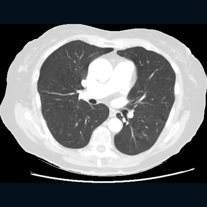 CT slice across the chest in a lung window, showing both lungs and the heart.