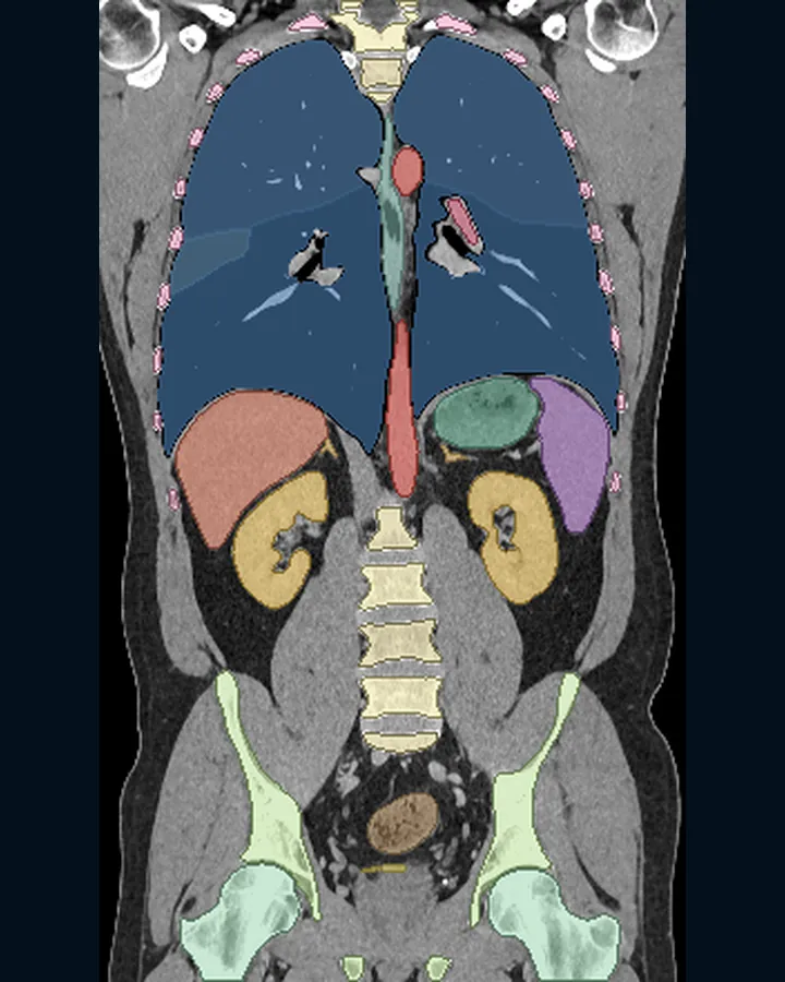 Coronal CT slice through the chest and abdomen with the lungs, heart, liver, kidneys, spleen, spine and pelvis coloured by organ.
