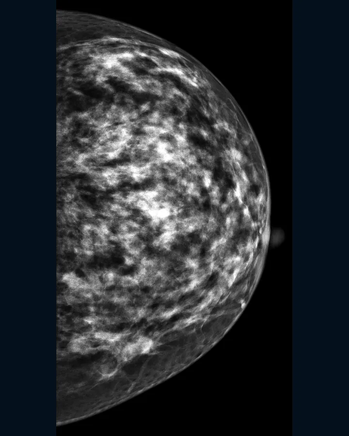 Mammogram picture showing the tissue of one breast.