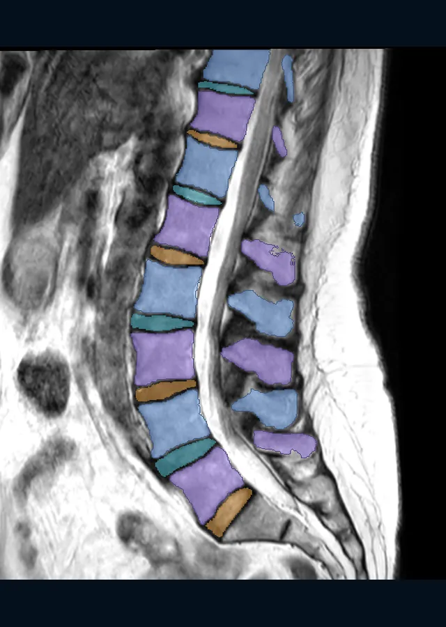 Side-on MRI of the lower spine with each vertebra and disc coloured separately.