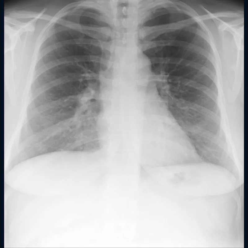 Front-view chest X-ray showing both lungs, the heart and the ribs.