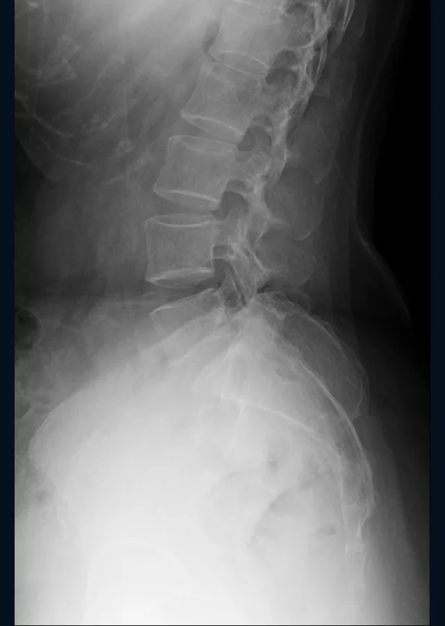 Side-view X-ray of the lower spine.