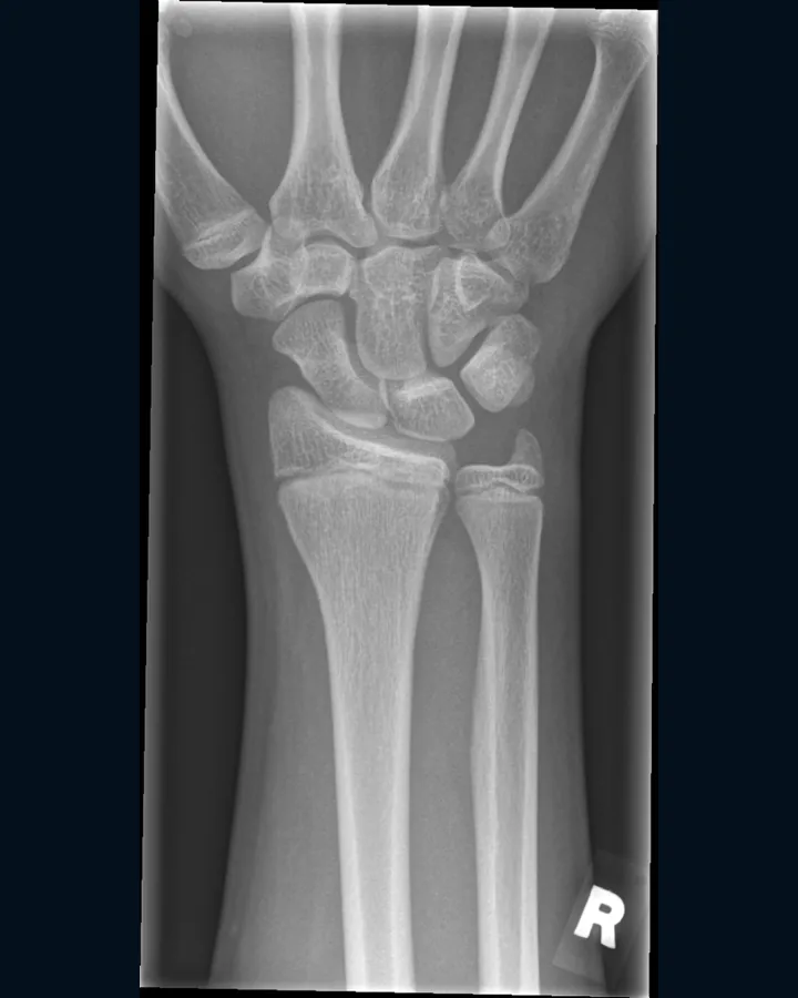 X-ray of a child's wrist and forearm bones.